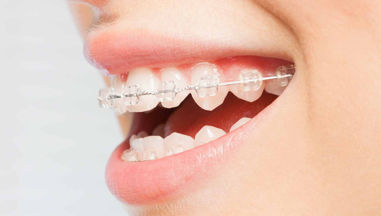 Ceramic Braces Adelaide - Clear Orthodontics - Orthodontic Smile Practice