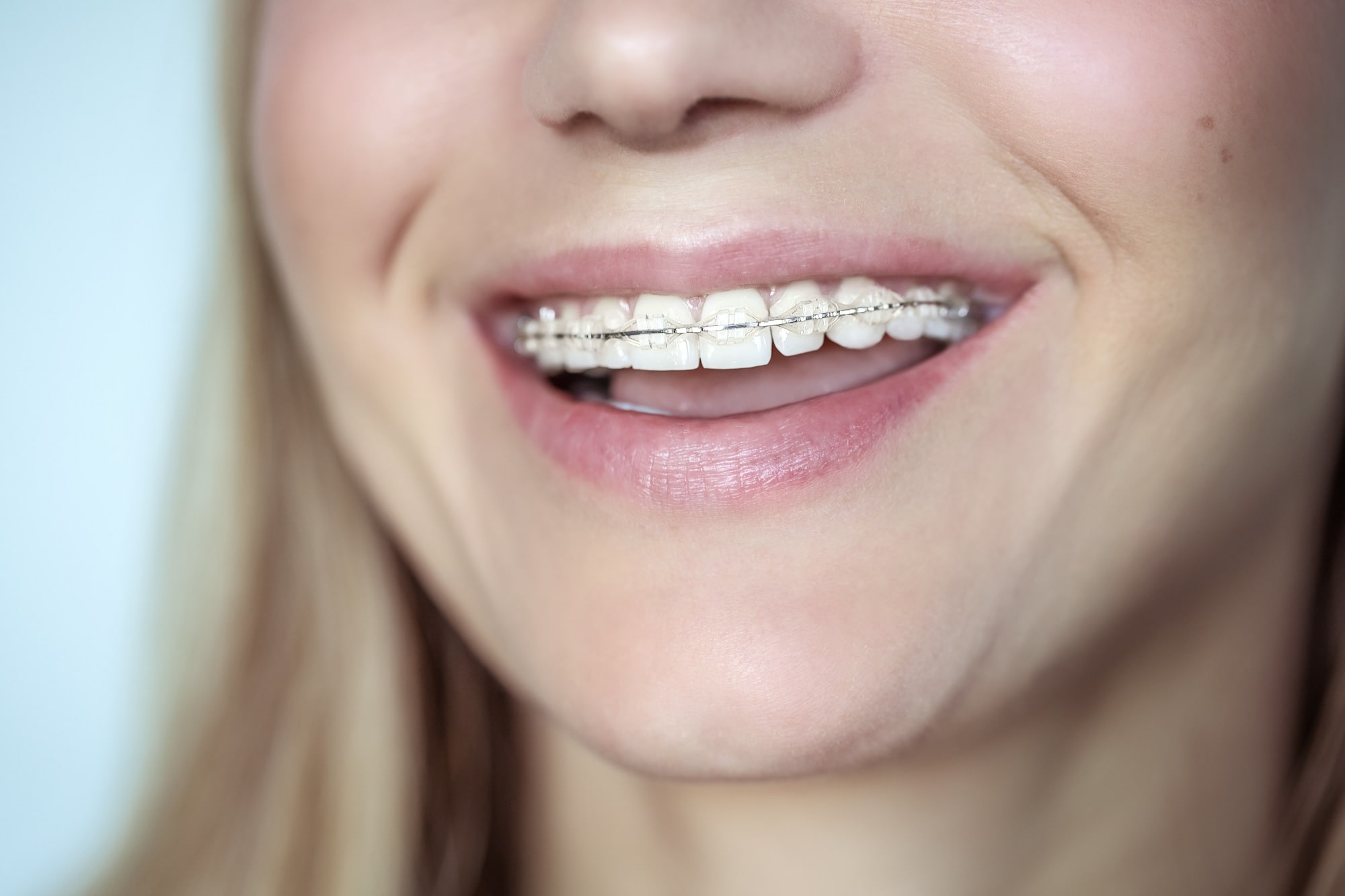 Ceramic Braces Adelaide - Clear Orthodontics - Orthodontic Smile